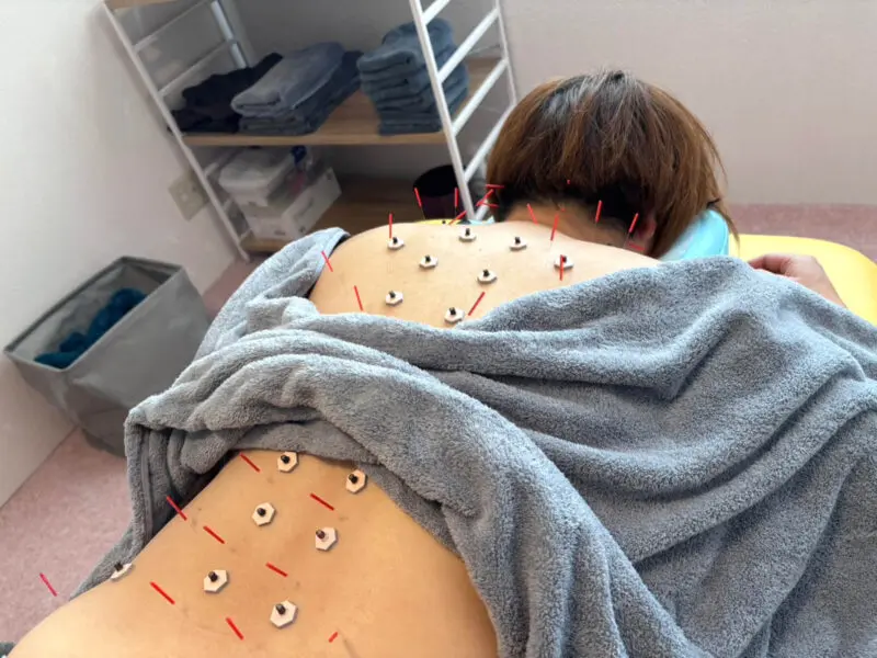 体験レポ】カレント高根沢2階「みずぬま鍼灸院」さんで鍼灸治療